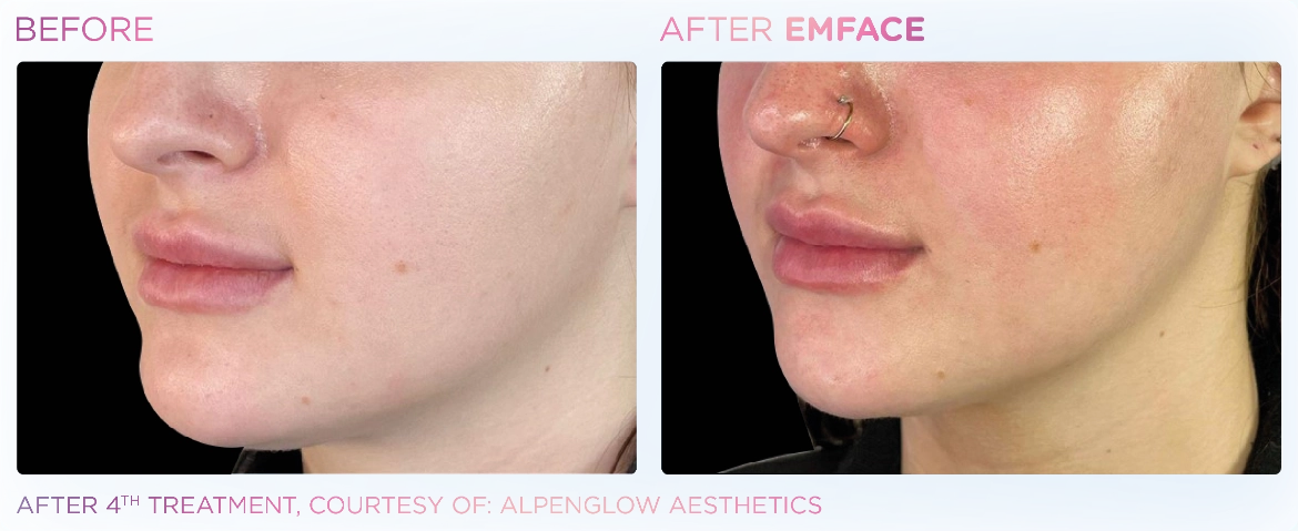 Emface_PIC_Ba-card-female-jawline-084_ENUS100-1