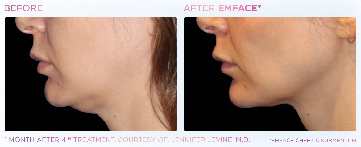 Emface_PIC_Ba-card-female-submentum-cheek-123_ENUS100