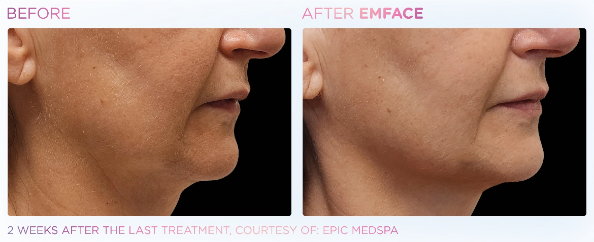 Emface_PIC_Ba-card-jawline-face-106_ENUS100