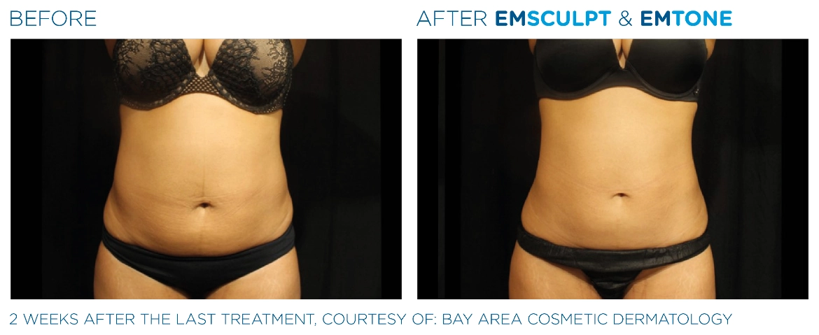 Emsculpt_Emtone_PIC_Ba-card-female-abdomen-002_EN100-1