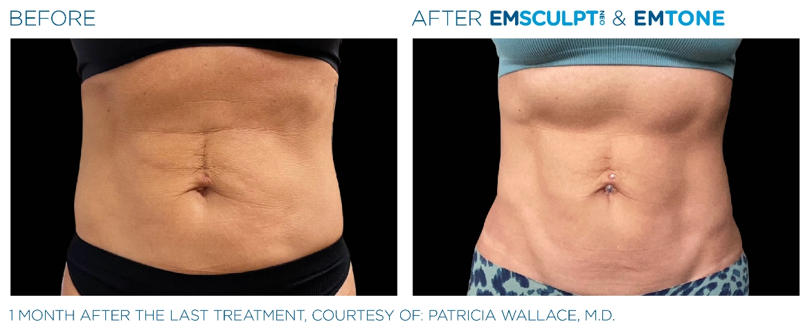Emsculpt_Neo-Emtone_PIC_Ba-card-female-abdomen-001_ENUS100-1