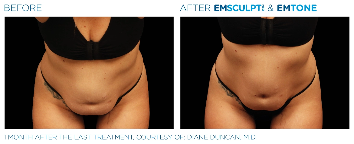 Emsculpt_Neo-Emtone_PIC_Ba-card-female-abdomen-003_ENUS100-1