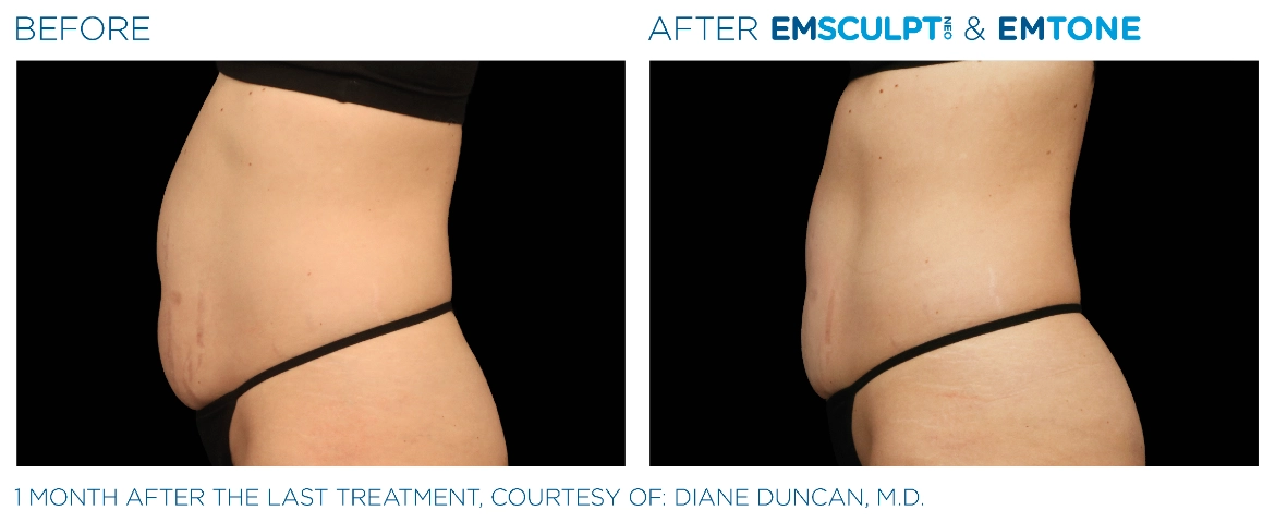 Emsculpt_Neo-Emtone_PIC_Ba-card-female-abdomen-004_ENUS100-1