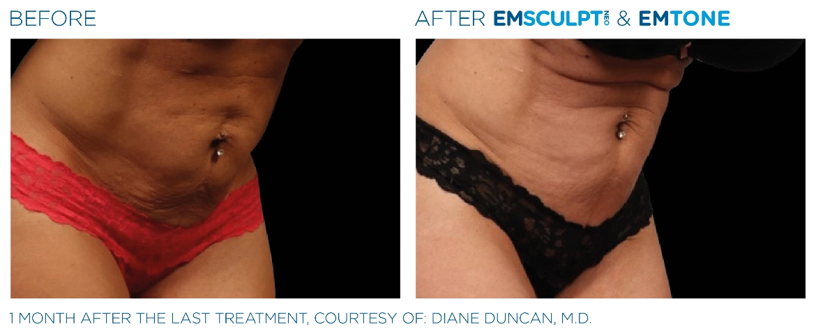 Emsculpt_Neo-Emtone_PIC_Ba-card-female-abdomen-010_ENUS100-1