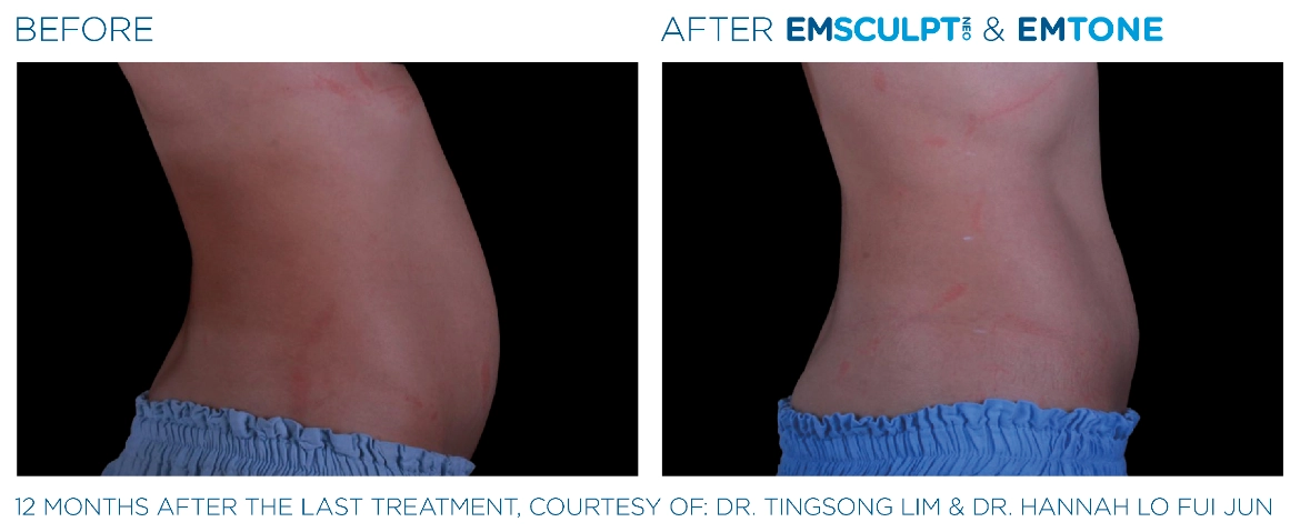 Emsculpt_Neo-Emtone_PIC_Ba-card-female-abdomen-020_ENUS100-1