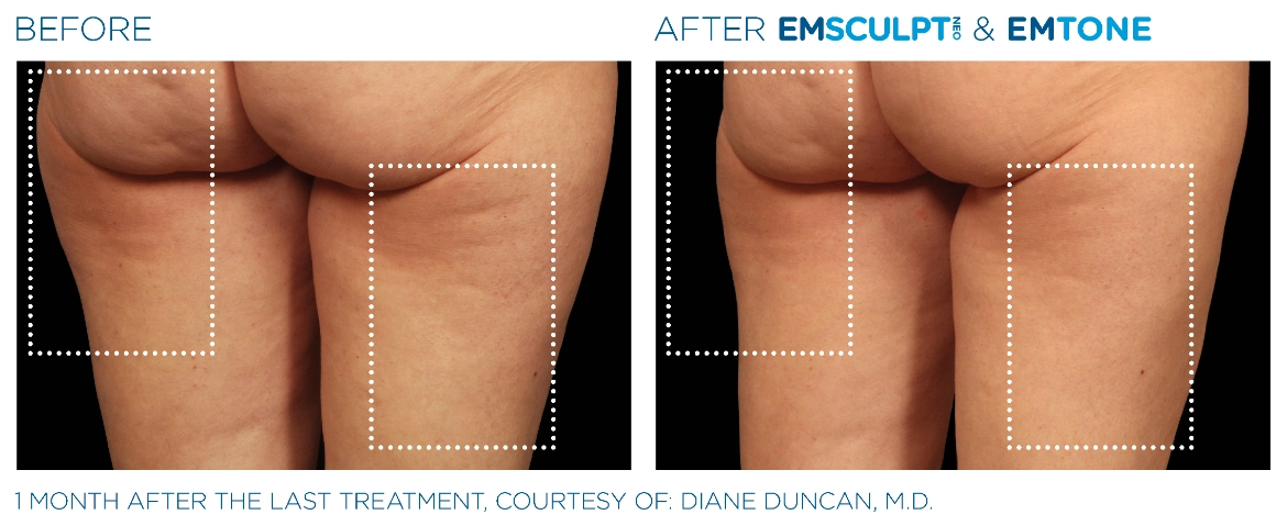 Emsculpt_Neo-Emtone_PIC_Ba-card-female-back-thigh-002_ENUS100-1