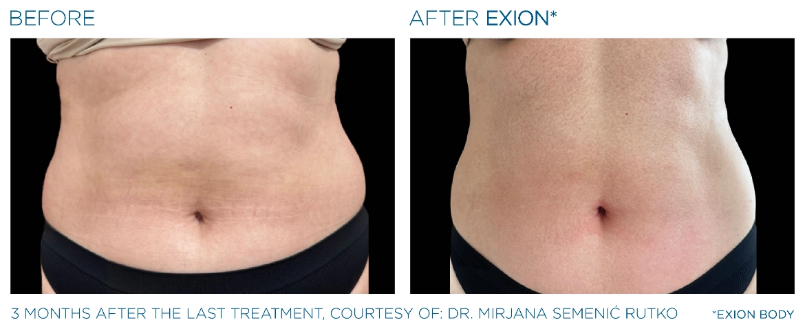 Exion_PIC_Ba-card-abdomen-female-081_Body_EN100