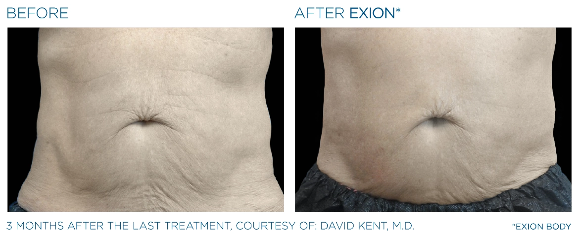 Exion_PIC_Ba-card-abdomen-male-019_Body_ENUS100