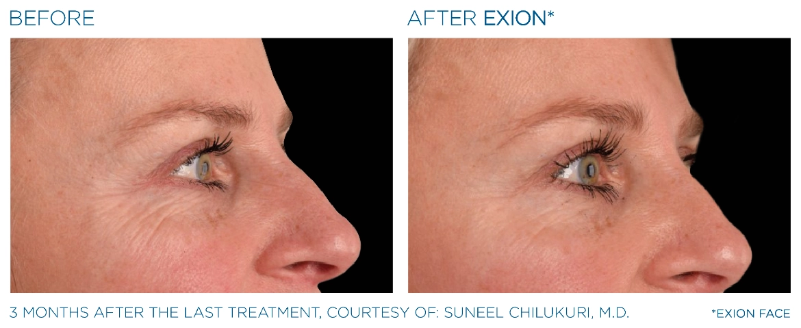 Exion_PIC_Ba-card-eyes-female-005_Face_ENUS100