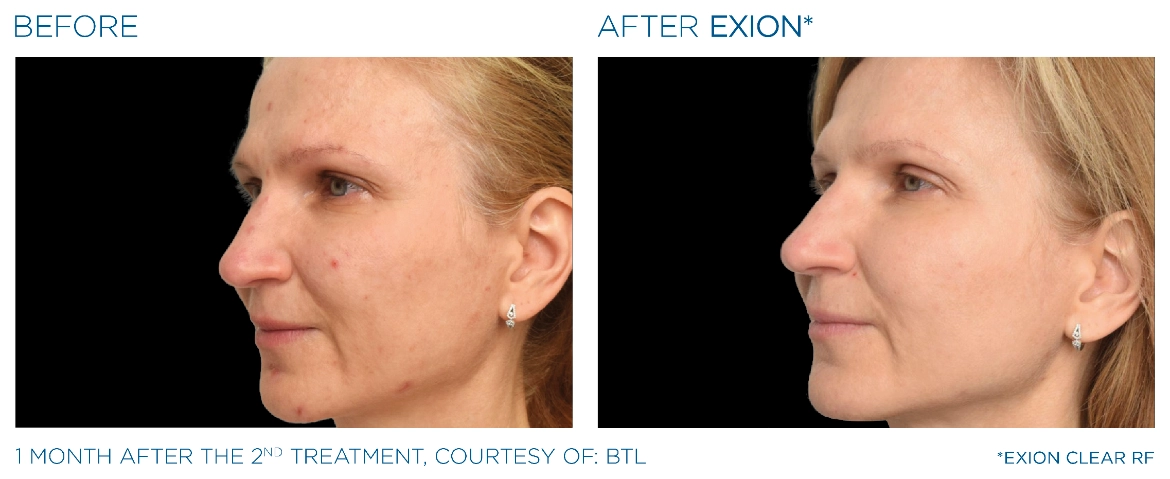 Exion_PIC_Ba-card-face-female-077_Clear_RF_EN100